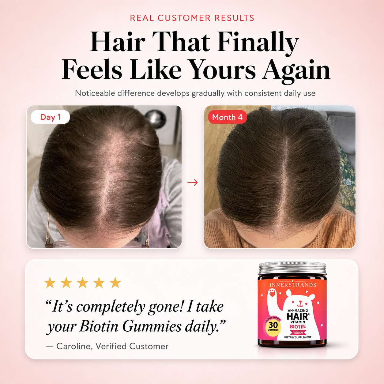 Woman holding InnerStrands biotin hair gummies for women daily hair vitamins routine